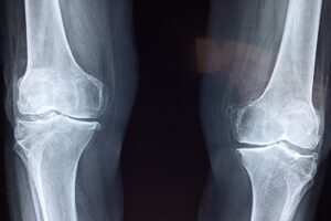 <strong>Let’s Talk About Bone Health</strong>